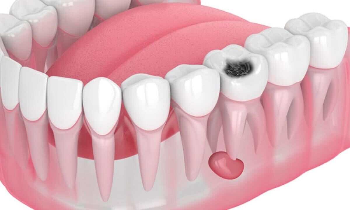 Dental Kist