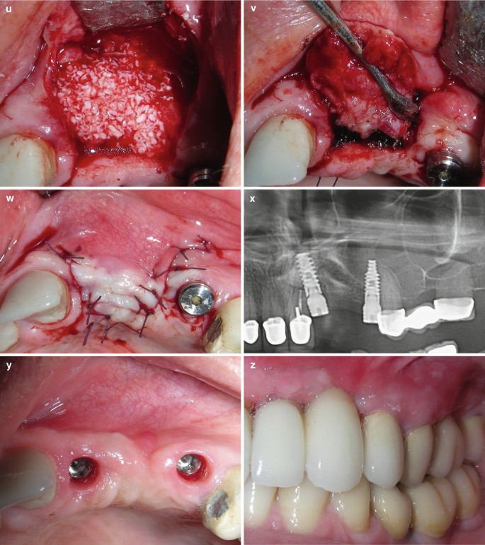 Diş əkimi və implant əməliyyatı